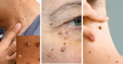 Orthoxiva™ Skin tag removal