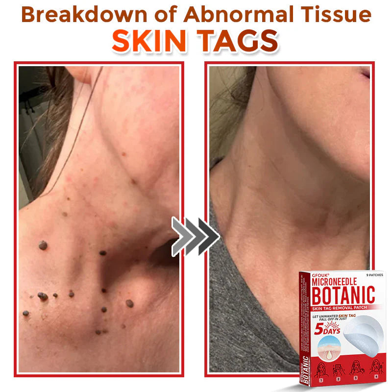 Orthoxiva™ Skin tag removal
