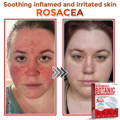 Orthoxiva™ Skin tag removal