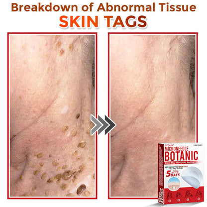 Orthoxiva™ Skin tag removal
