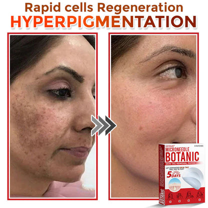 Orthoxiva™ Skin tag removal