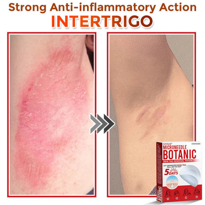 Orthoxiva™ Skin tag removal