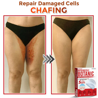 Orthoxiva™ Skin tag removal