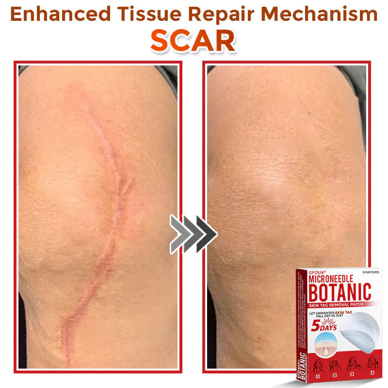 Orthoxiva™ Skin tag removal