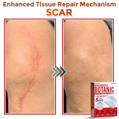 Orthoxiva™ Skin tag removal