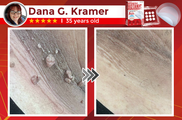 Orthoxiva™ Skin tag removal