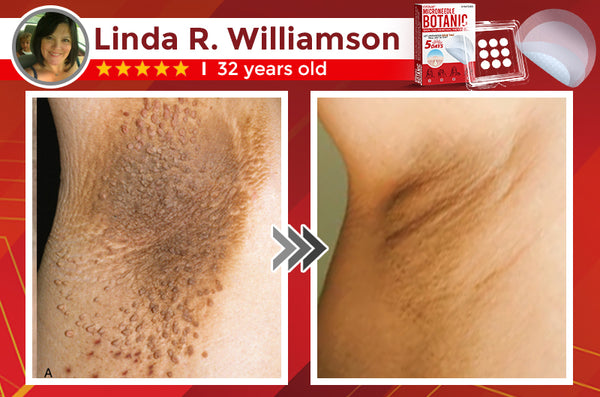 Orthoxiva™ Skin tag removal