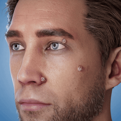 Orthoxiva™ Skin tag removal