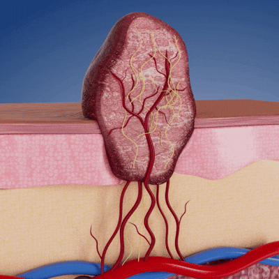 Orthoxiva™ Skin tag removal