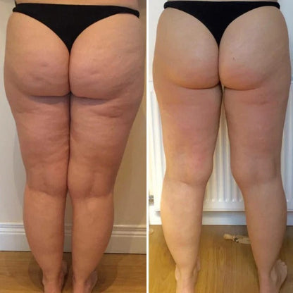 Orthoxiva™ - Anti-Cellulite Rotating Massager