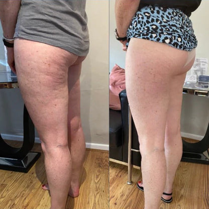 Orthoxiva™ - Anti-Cellulite Rotating Massager